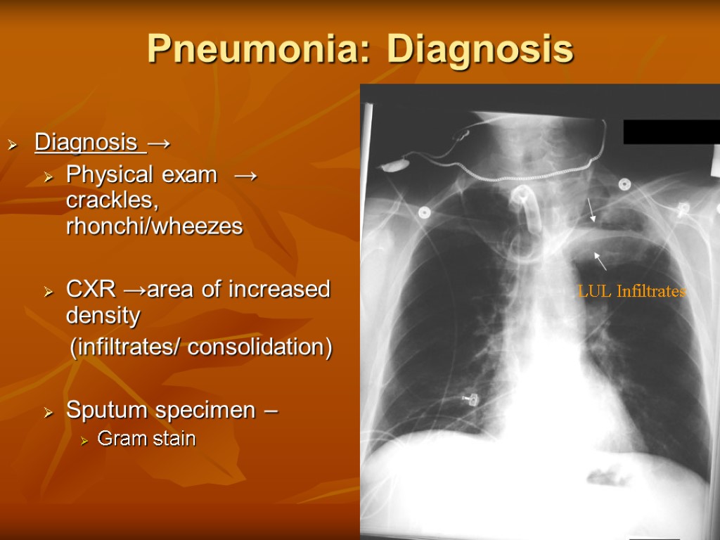 Pneumonia: Diagnosis Diagnosis → Physical exam → crackles, rhonchi/wheezes CXR →area of increased density